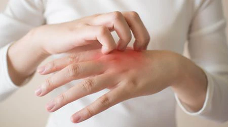 Some pests in Dubai cause allergies