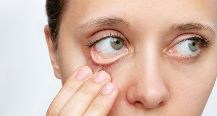 10 Symptoms You Are Iron Deficient